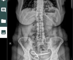 X-Ray Reveals Reason For Woman’s Stomach Pains