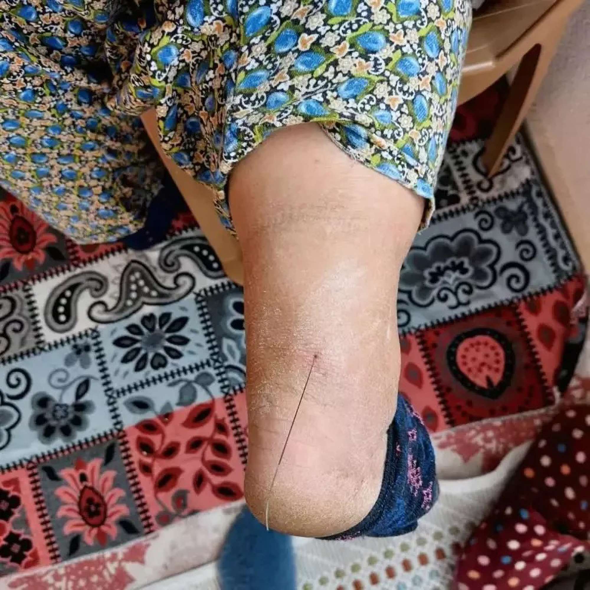 Baffled Surgeons Pull 14-Inch Wire From Woman’s Heel